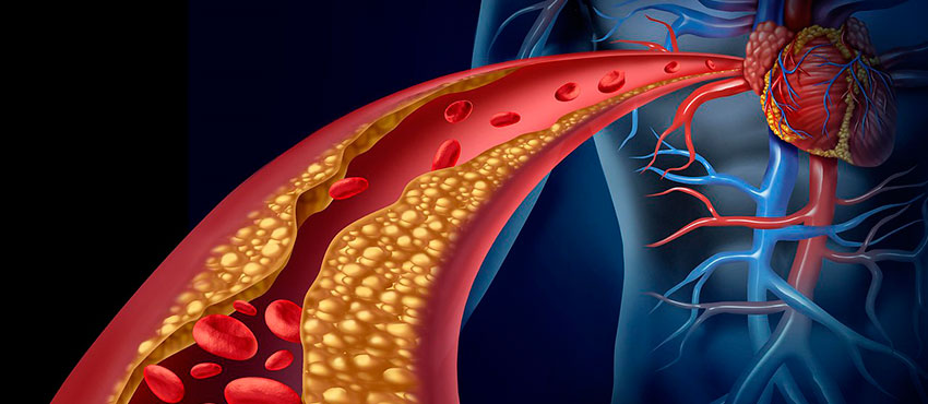 Атеросклероз артерий - симптомы, причины